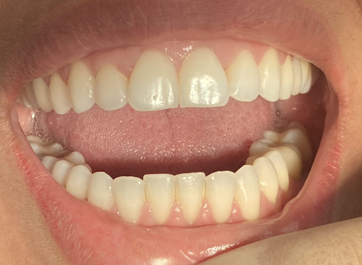 Sorriso antes do tratamento com alinhadores