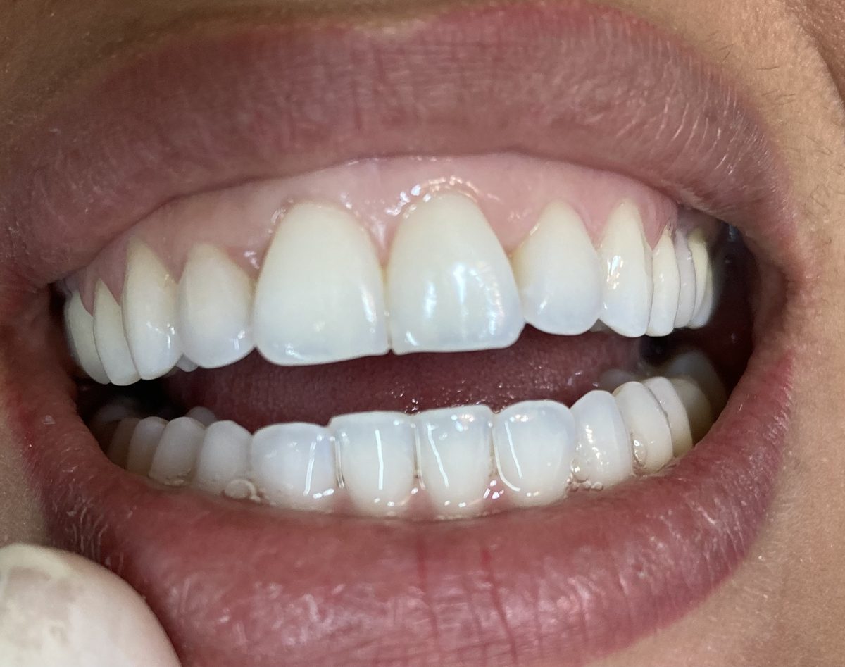 Sorriso depois do tratamento com alinhadores e clareamento