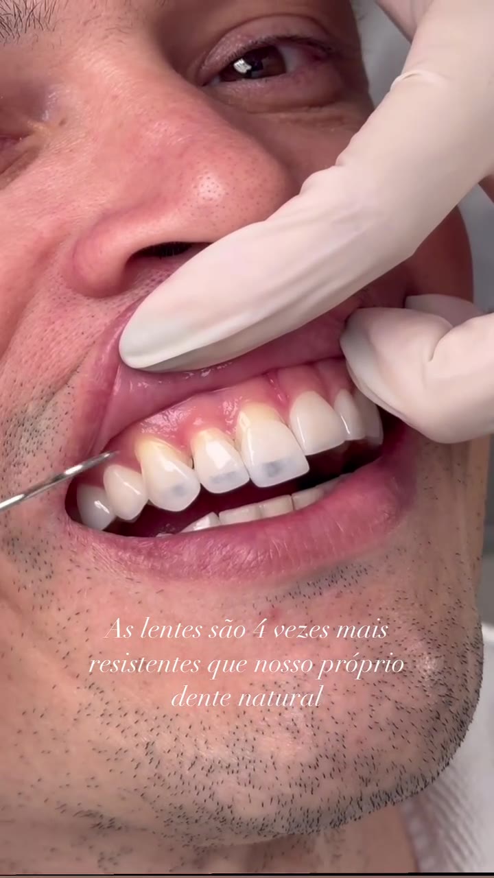 Prova de lentes de contato dental na SORRIE+